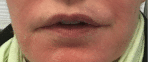 After Image: Lip Reduction