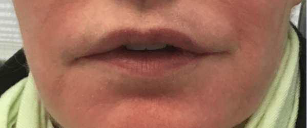 After Image: Lip Reduction - front