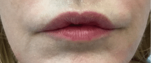 Before Image: Lip Reduction
