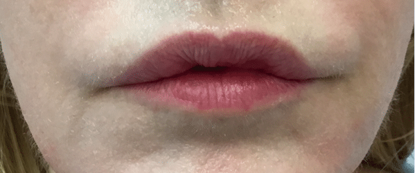 Before Image: Lip Reduction - front