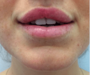 After Image: Lip Enhancement