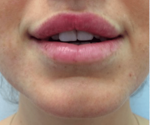 After Image: Lip Enhancement - front