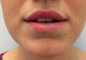 Before Image: Lip Enhancement