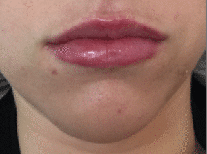 After Image: Lip Enhancement