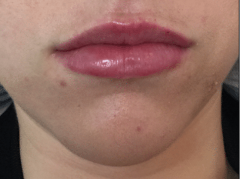 After Image: Lip Enhancement - front