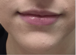 Before Image: Lip Enhancement