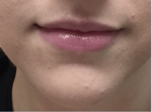Before Image: Lip Enhancement - front