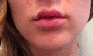 After Image: Lip Enhancement