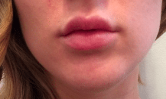 After Image: Lip Enhancement - front