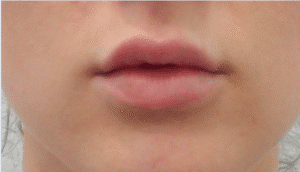 Before Image: Lip Enhancement