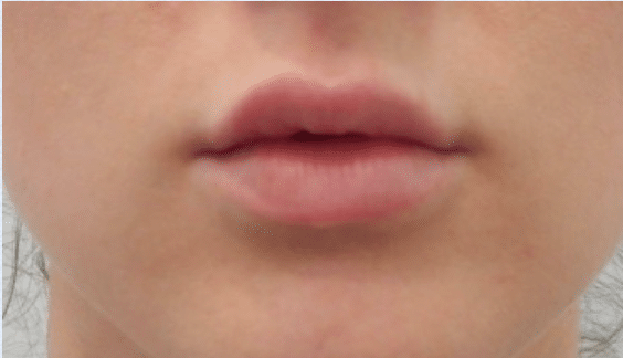 Before Image: Lip Enhancement - front