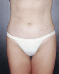 After Image: Liposuction - front