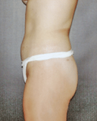 After Image: Liposuction - left-side