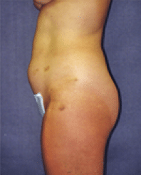 Before Image: Liposuction - left-side