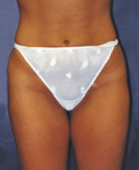 After Image: Liposuction - front