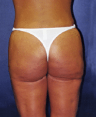 After Image: Liposuction - back