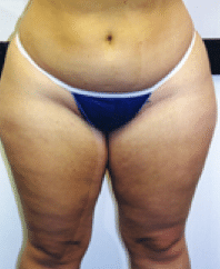 Before Image: Liposuction - front