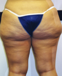 Before Image: Liposuction - back