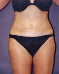 After Image: Liposuction - front