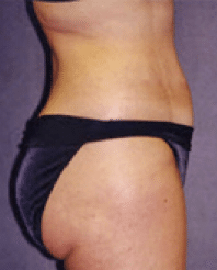 After Image: Liposuction - right-side