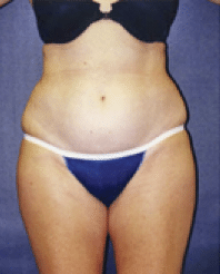 Before Image: Liposuction - front