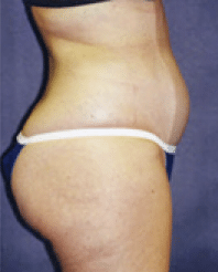 Before Image: Liposuction - right-side