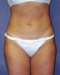 After Image: Liposuction - front