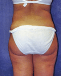 After Image: Liposuction - back