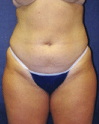 Before Image: Liposuction - front