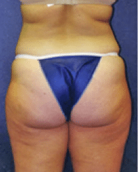 Before Image: Liposuction - back