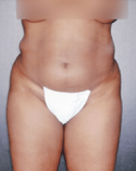 Before Image: Liposuction - front