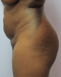 Before Image: Liposuction - left-side