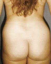 Before Image: Liposuction - back