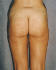 After Image: Liposuction - back