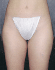 After Image: Liposuction - front