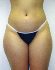 Before Image: Liposuction - front
