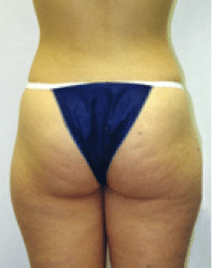 Before Image: Liposuction - back