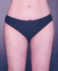 After Image: Liposuction - front