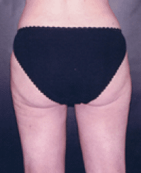 After Image: Liposuction - back