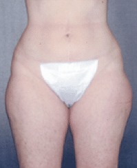 Before Image: Liposuction - front