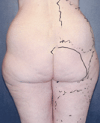 Before Image: Liposuction - back