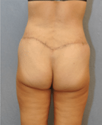 After Image: Lower Body Lift - back