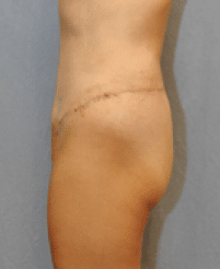 After Image: Lower Body Lift - left-side