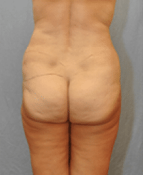 Before Image: Lower Body Lift - back