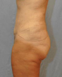 Before Image: Lower Body Lift - left-side