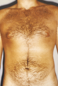 After Image: Male Body Contouring - front