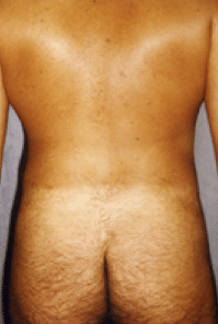 After Image: Male Body Contouring - back