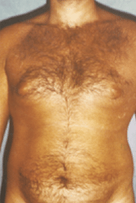 Before Image: Male Body Contouring - front