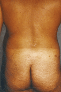 Before Image: Male Body Contouring - back