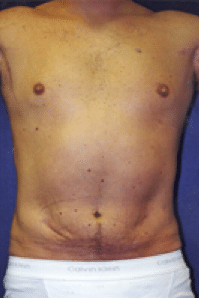 After Image: Male Body Contouring - front